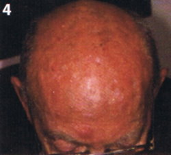 Kopfhaut eines männlichen Patienten
