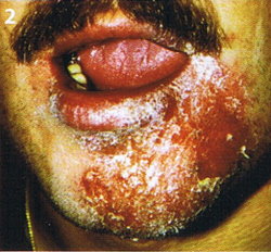 Infifizierte Unterkiefer eines männlichen Patienten